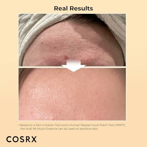 Comparison of skin before and after using COSRX product, showing reduced blemishes and smoother texture.