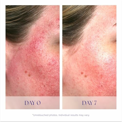 Comparison of skin redness on day 0 and day 7.